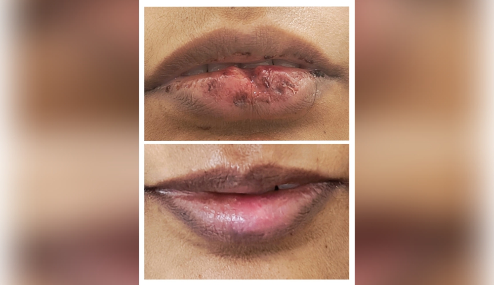 Lip Repair Surgery